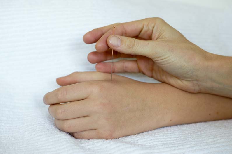 Akupunkturnadel in der Hand